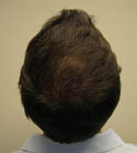 Ryan Hair Transplant Crown View 8 Months
