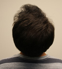 Ryan Hair Transplant Crown View 9 Months