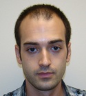 Ryan Hair Transplant Front View Before