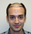 Ryan Hair Transplant Front View Target Area