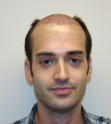 Ryan Hair Transplant Front View Immediately After
