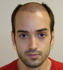 Ryan Hair Transplant Front View 4 Days