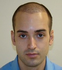 Ryan Hair Transplant Front View 6 Days