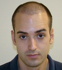 Ryan Hair Transplant Front View 7 Days
