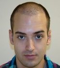 Ryan Hair Transplant Front View 8 Days