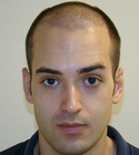Ryan Hair Transplant Front View 9 Days