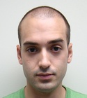 Ryan Hair Transplant Front View 12 Days