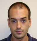 Ryan Hair Transplant Front View 3 Months