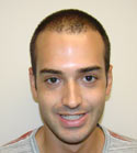 Ryan Hair Transplant Front View 5 Months
