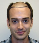 Ryan Hair Transplant Shaved Head