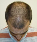 Ryan Hair Transplant Front Tilt 5 Months