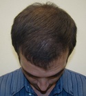 Ryan Hair Transplant Front Tilt 7 Months