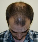 Ryan Hair Transplant Front Tilt Before
