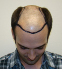 Ryan Hair Transplant Front Tilt Target Area
