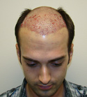 Ryan Hair Transplant Front Tilt Immediately After