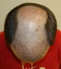 Ryan Hair Transplant Front Tilt 4 Days