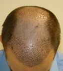 Ryan Hair Transplant Front Tilt 6 Days