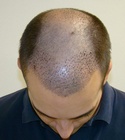 Ryan Hair Transplant Front Tilt 7 Days