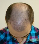 Ryan Hair Transplant Front Tilt 8 Days