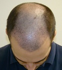 Ryan Hair Transplant Front Tilt 9 Days