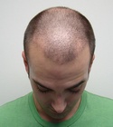 Ryan Hair Transplant Front Tilt 12 Days