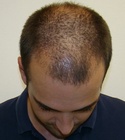 Ryan Hair Transplant Front Tilt 3 Months