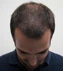 Ryan Hair Transplant Front Tilt 6 Months