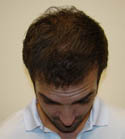 Ryan Hair Transplant Front Tilt 8 Months