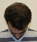 Ryan Hair Transplant Front Tilt 9 Months