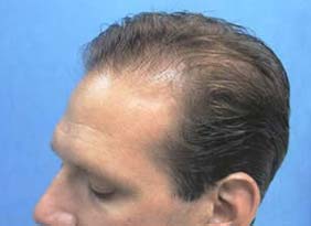 Josh before hair transplant