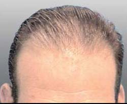 Josh before hair transplant