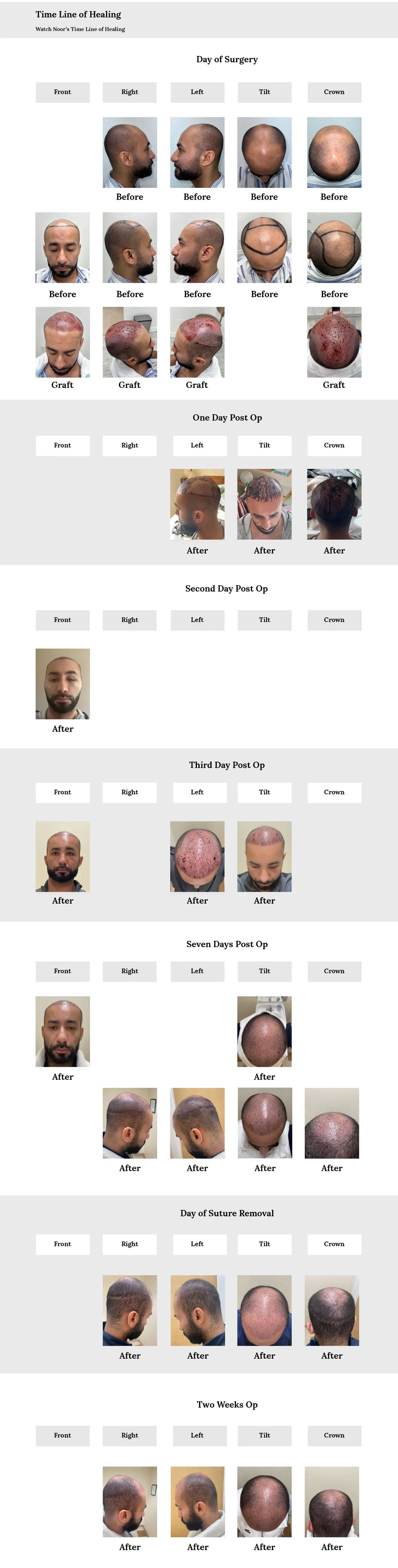 Hair Transplant Healing Timeline
